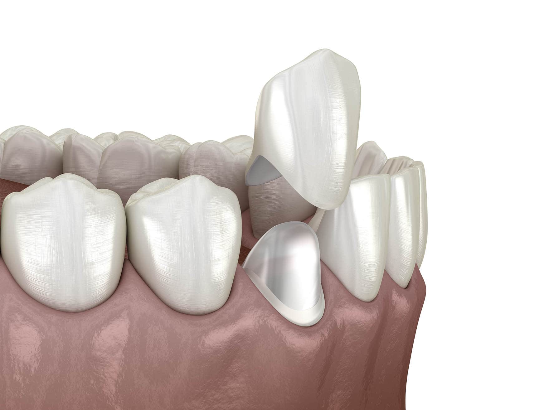 Ceramic Crowns