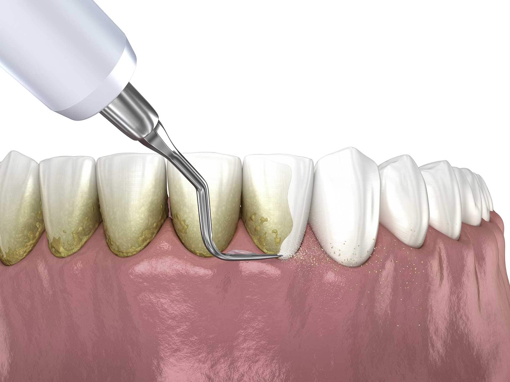 periodontal treatment/deep cleaning