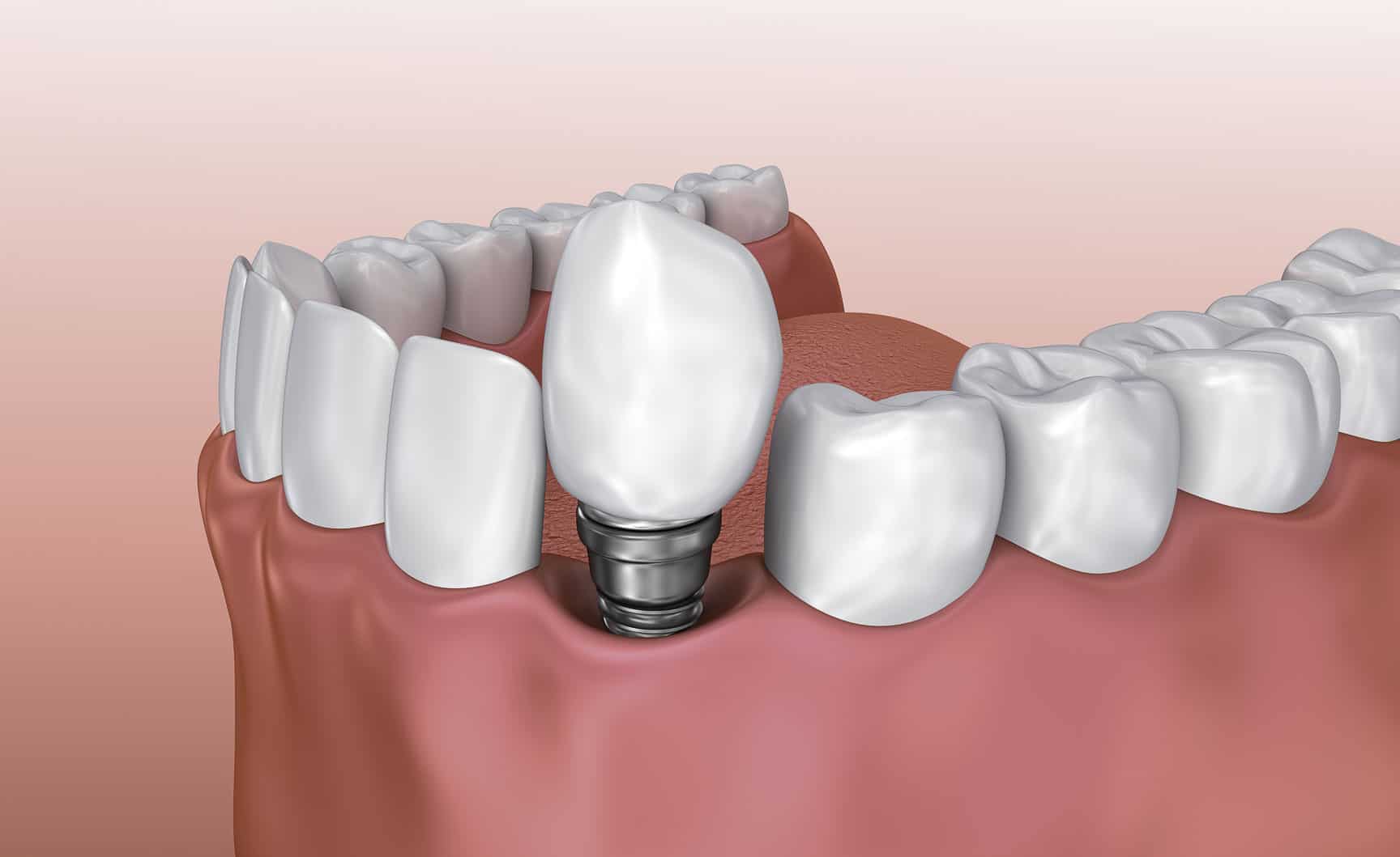 dental implants