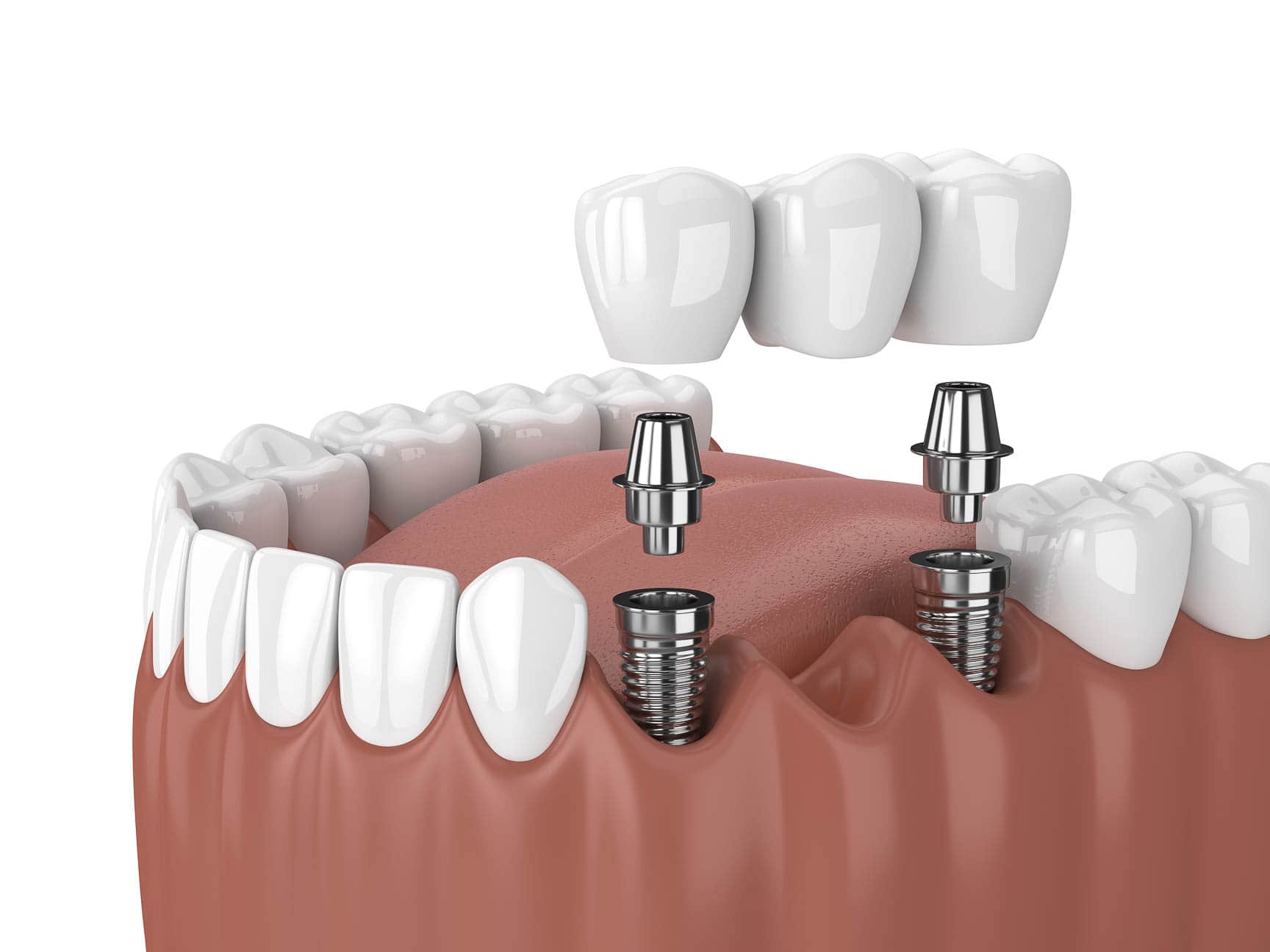 implant bridges