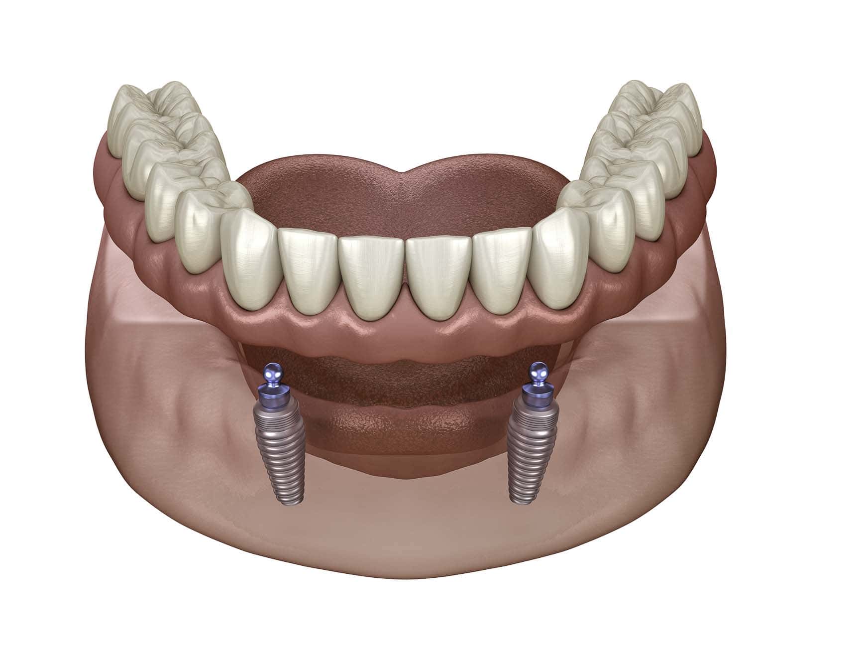 implant dentures