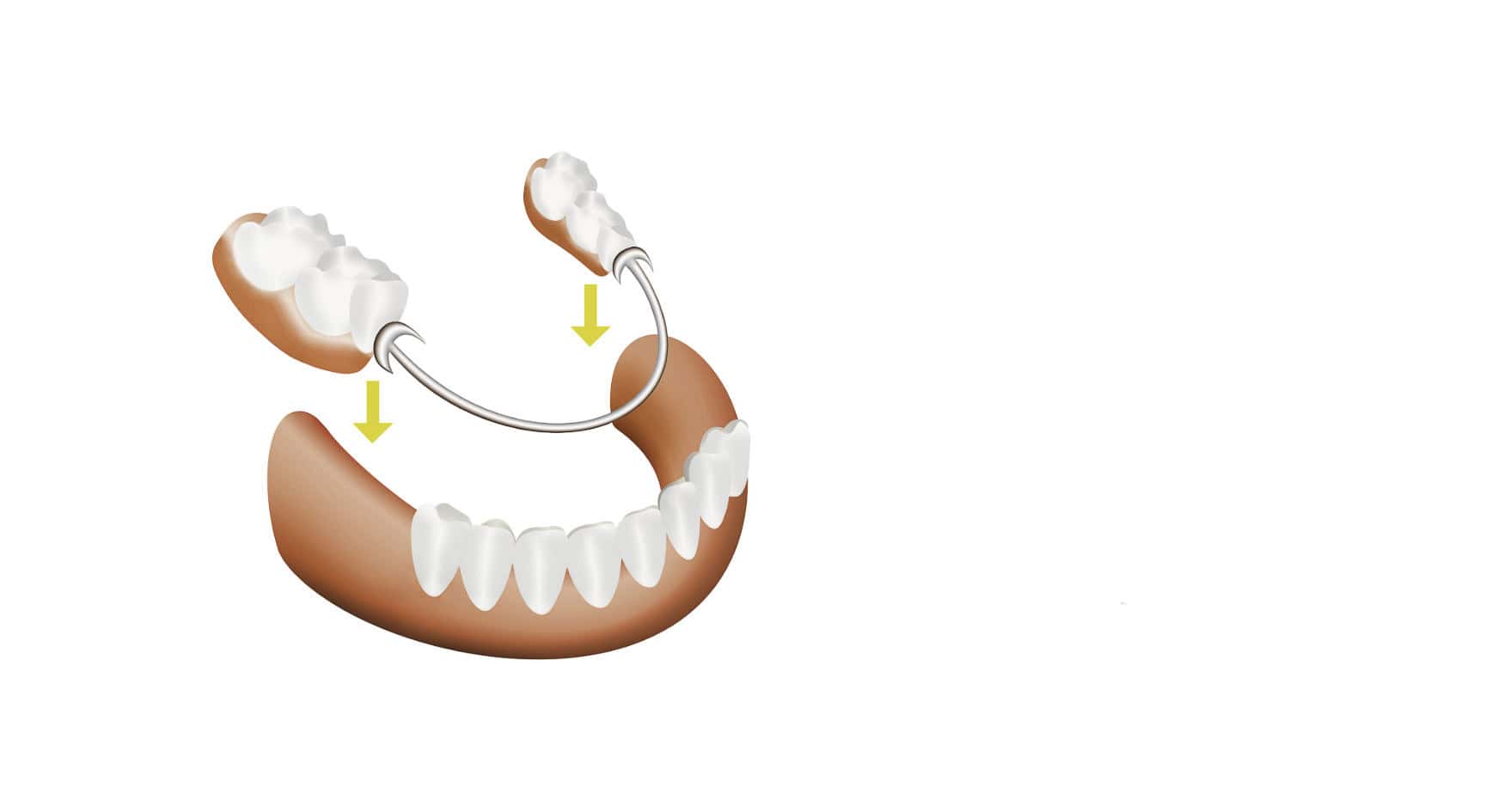 removable partial dentures