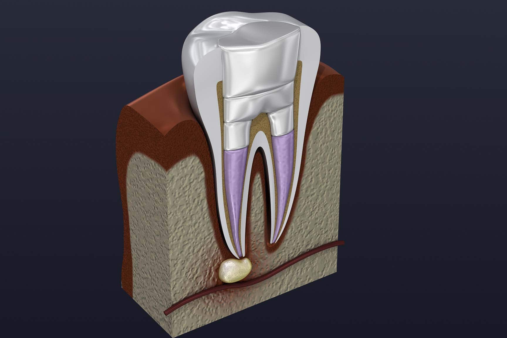 root canal treatment