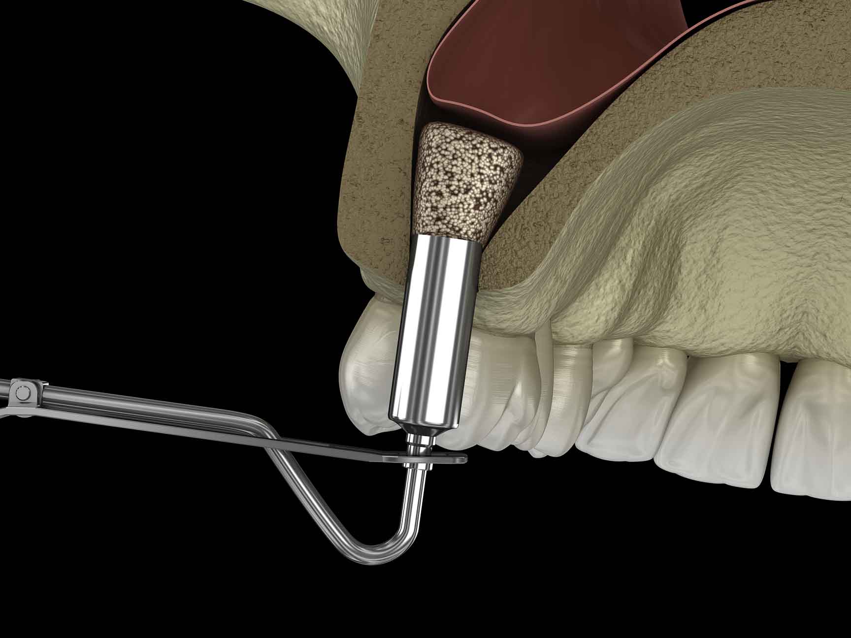 sinus lift